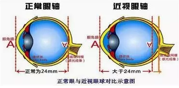 近視眼球突出？！控制近視度數(shù)加深是關(guān)鍵！