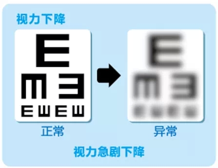 視網(wǎng)膜脫離啥癥狀？這張圖告訴你！