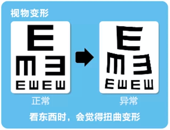 視網(wǎng)膜脫離啥癥狀？這張圖告訴你！