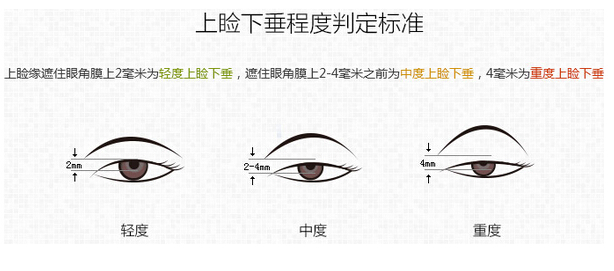 先天性上瞼下垂的不良影響