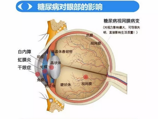 你造嗎？糖尿病晚期眼睛會致盲！