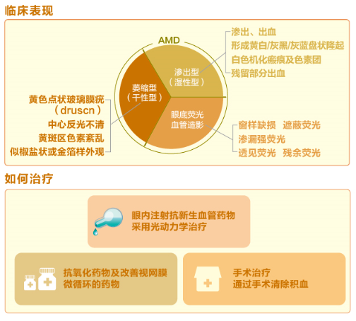 【看圖解】老年黃斑變性是怎么回事