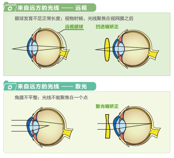 【看圖解】一張圖教你看懂近視、遠視和散光