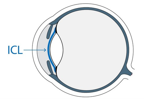 ICL晶體植入術(shù)，矯正的高度近視“神器”
