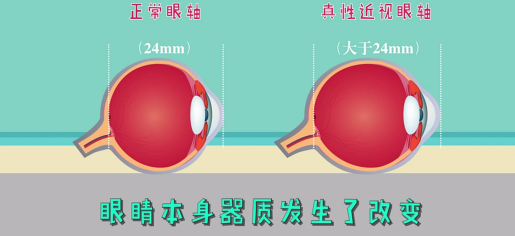 家長該如何辨別孩子的真假性近視?